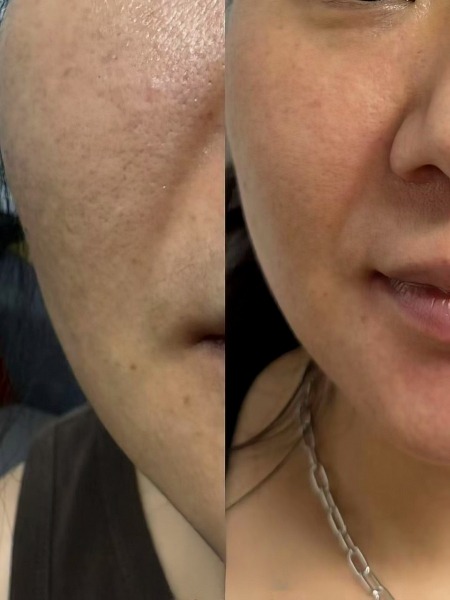 Voor en na pico-laser behandeling wangen